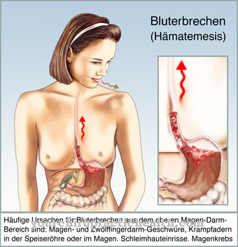 Vomiting of blood (hematemesis)