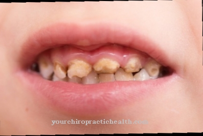 Brown spots on the teeth