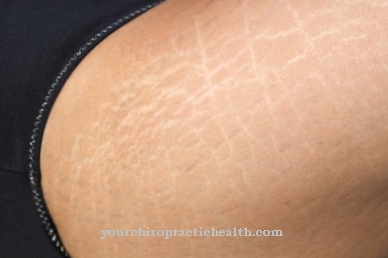 Stretch marks