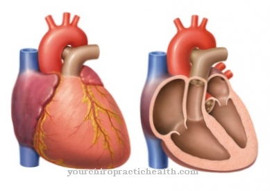 Cardiomegaly