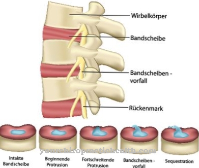 Platyspondyly