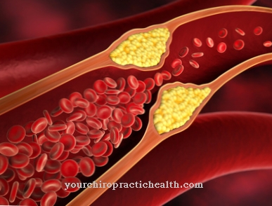 Post-ischemic syndrome