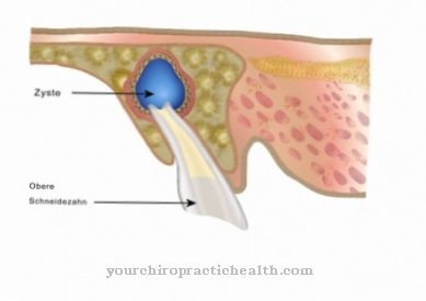 cyst